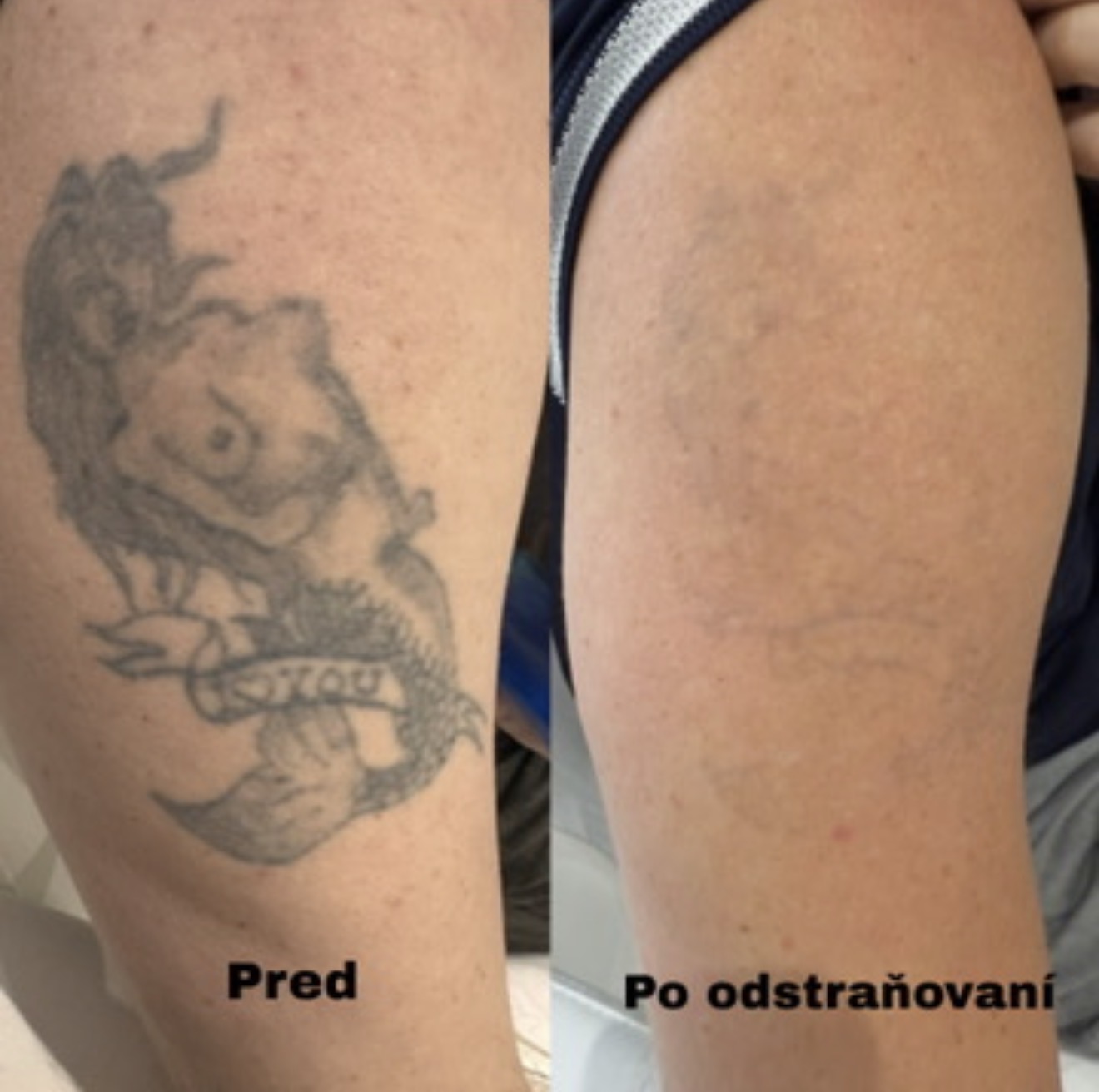 Odstránenie tetovania na stehne — pred a po