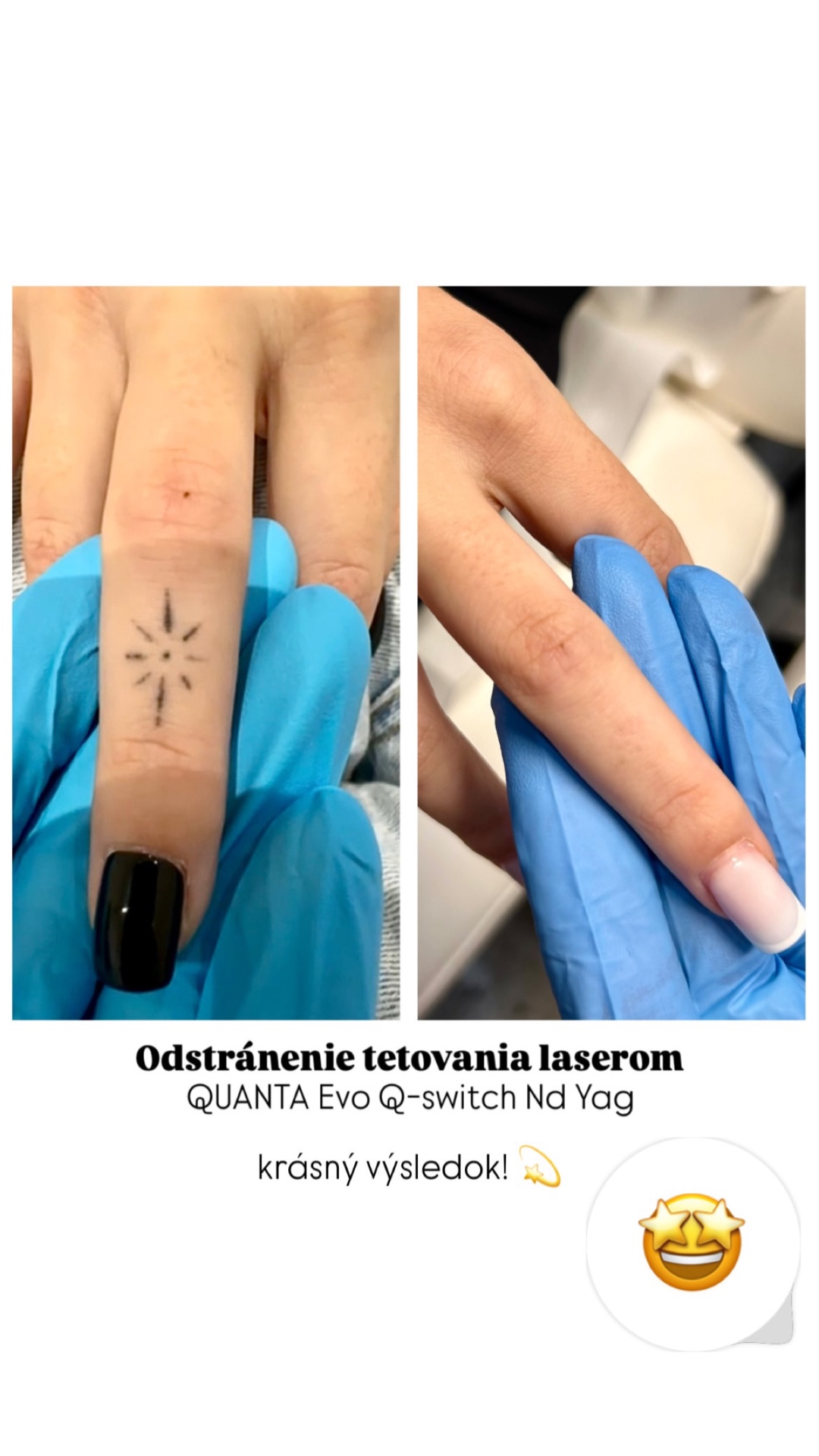 Odstránenie tetovania na prste laserom QUANTA Evo Q-switch Nd:YAG