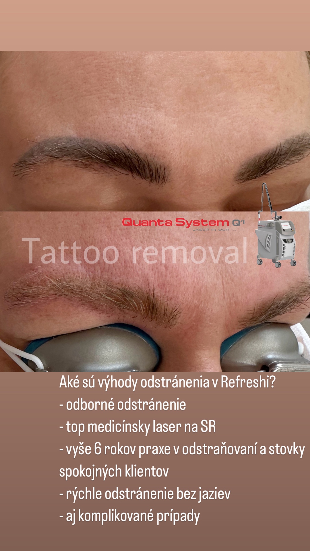 Odstránenie permanentného obočia laserom Quanta Q1