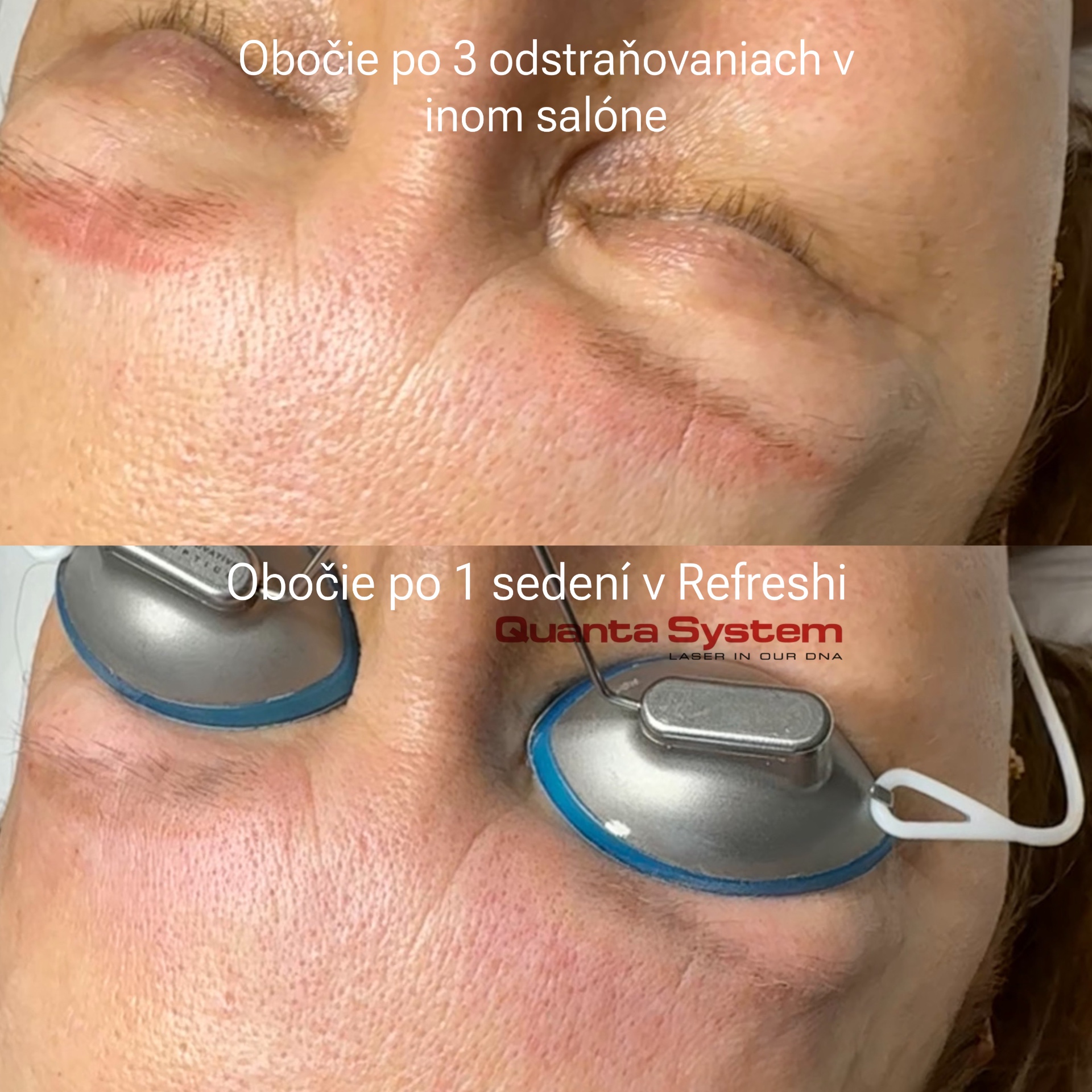 Porovnanie obočia po 3 sedeniach v inom salóne vs. 1 sedenie v Refresh